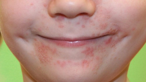 To how treat naturally perioral dermatitis Natural Perioral