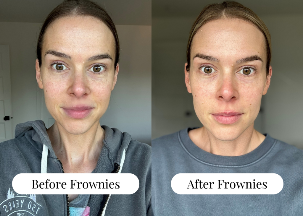 woman before wearing Frownies compared to after wearing Frownies
